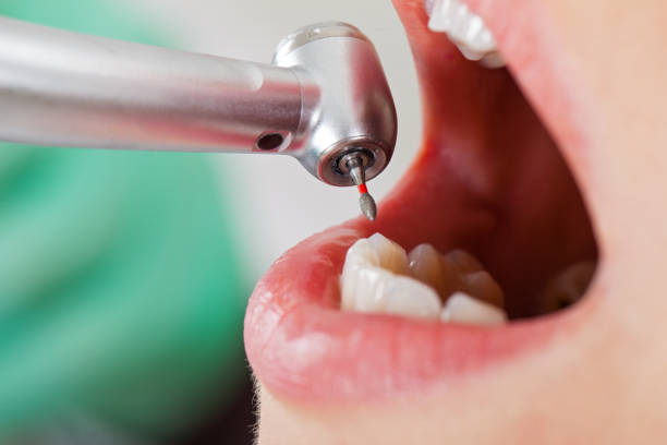 Best Root Canal Emergency Dentist  in Comanche, TX